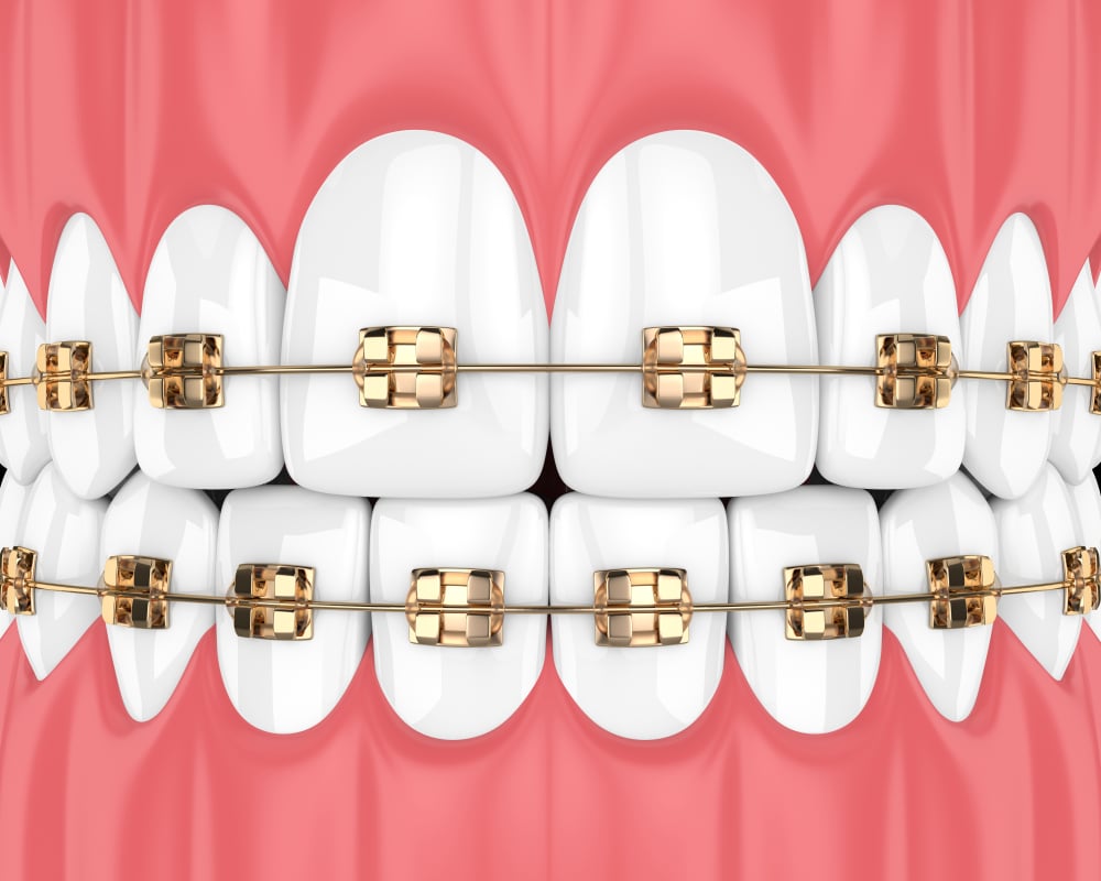 Your Complete Guide to Gold Braces Aloha Orthodontics Your Las