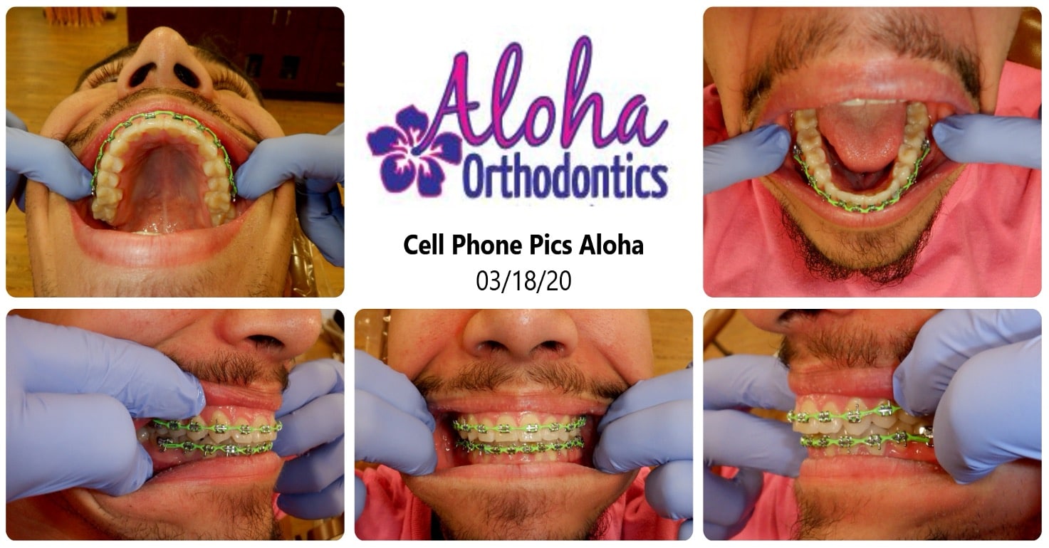 virtual braces check at aloha